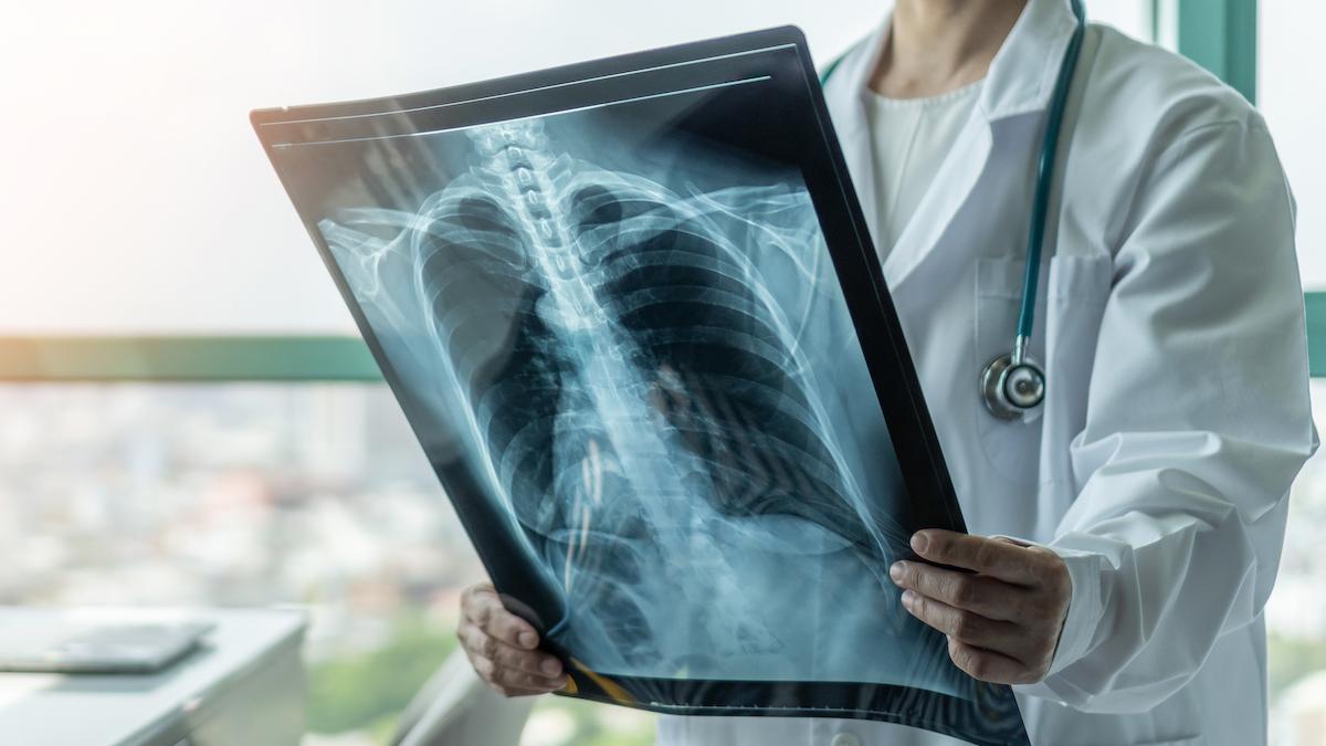Nou fàrmac per al càncer de pulmó: a qui va dirigida la nova teràpia?